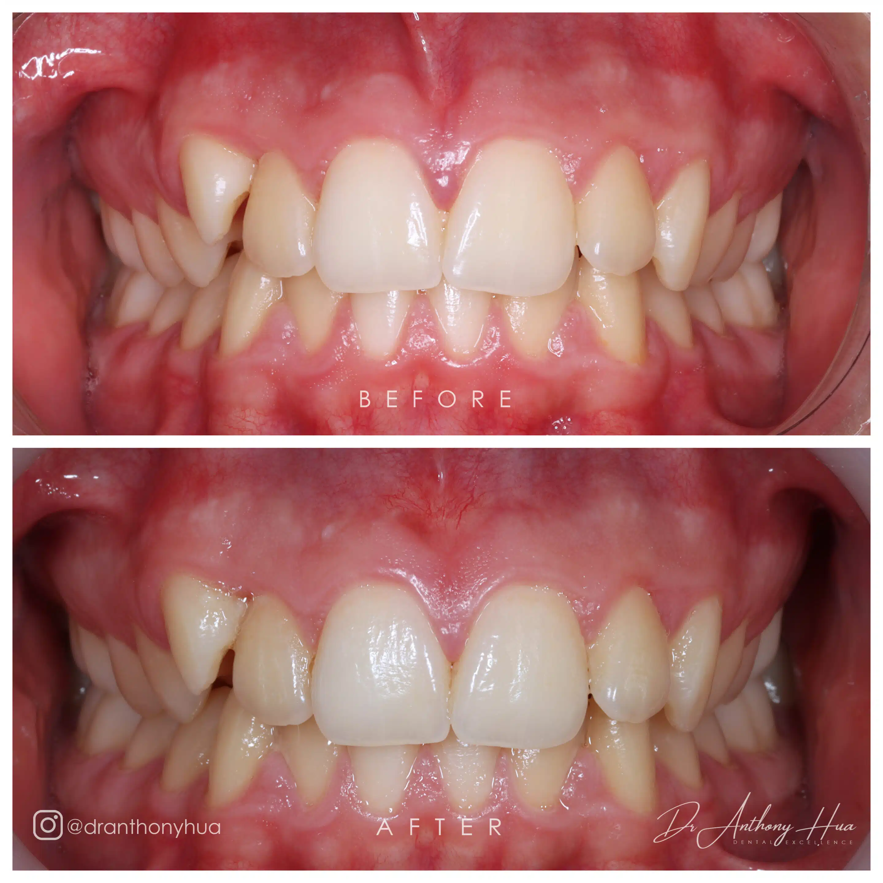 Laser Frenectomy before and after procedure at burleigh dental studio