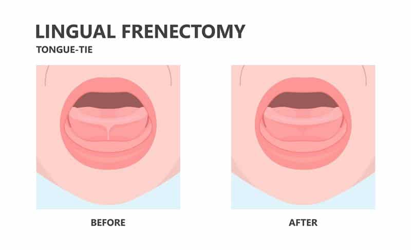 lingual frenectomy