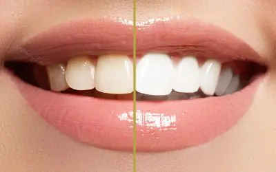 Professional Teeth Whitening: Is It Worth The Investment?