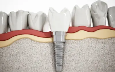 Factors That Influence Dental Implant Cost on the Gold Coast