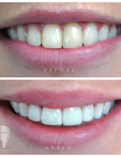 Smile Model V3 — Dentist In Burleigh Heads, QLD