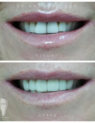 Smile Model V4 — Dentist In Burleigh Heads, QLD
