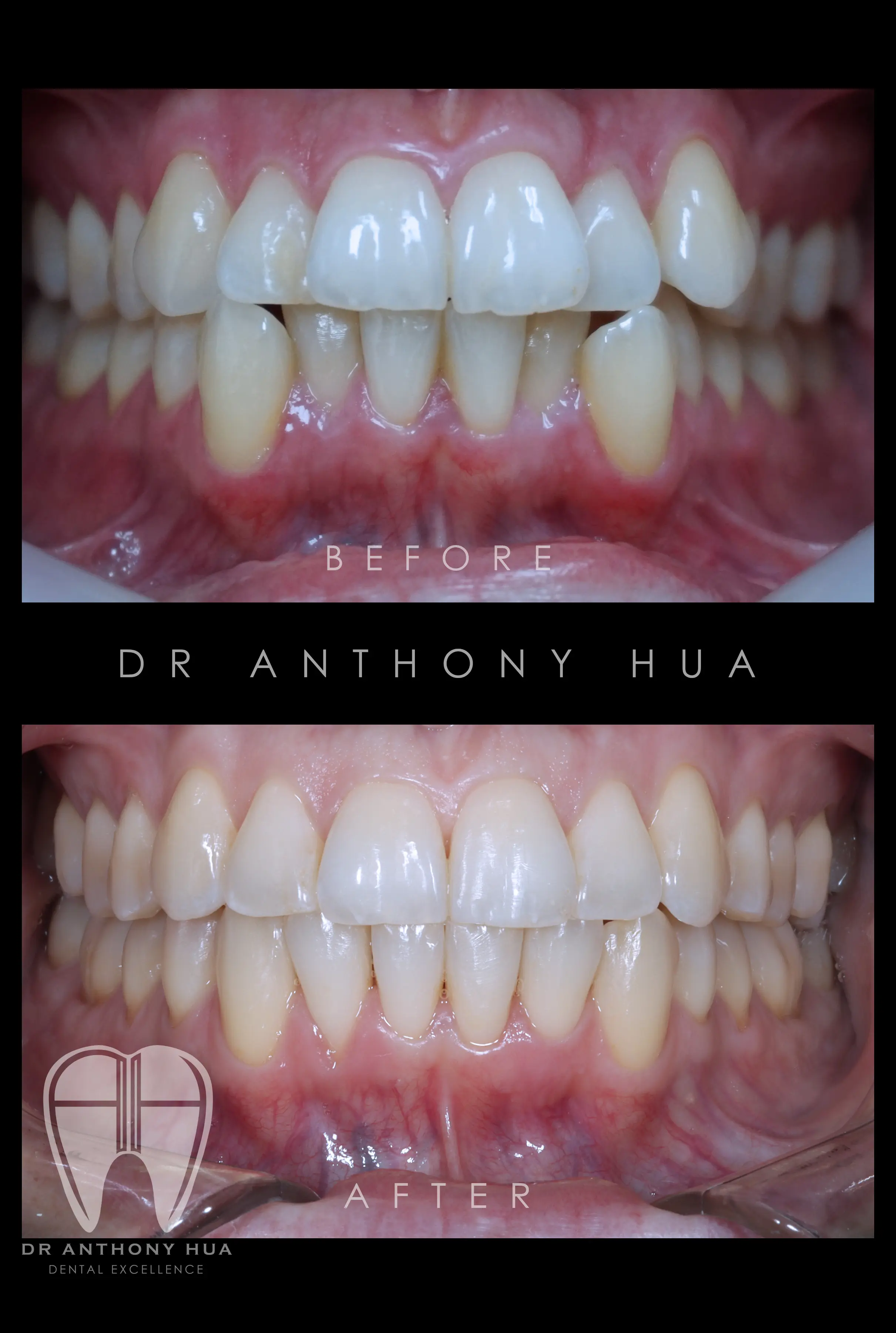 Gummy Smile Treatment Burleigh Dental Studio
