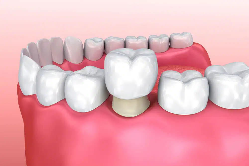 3D Dental Crown Installation Process