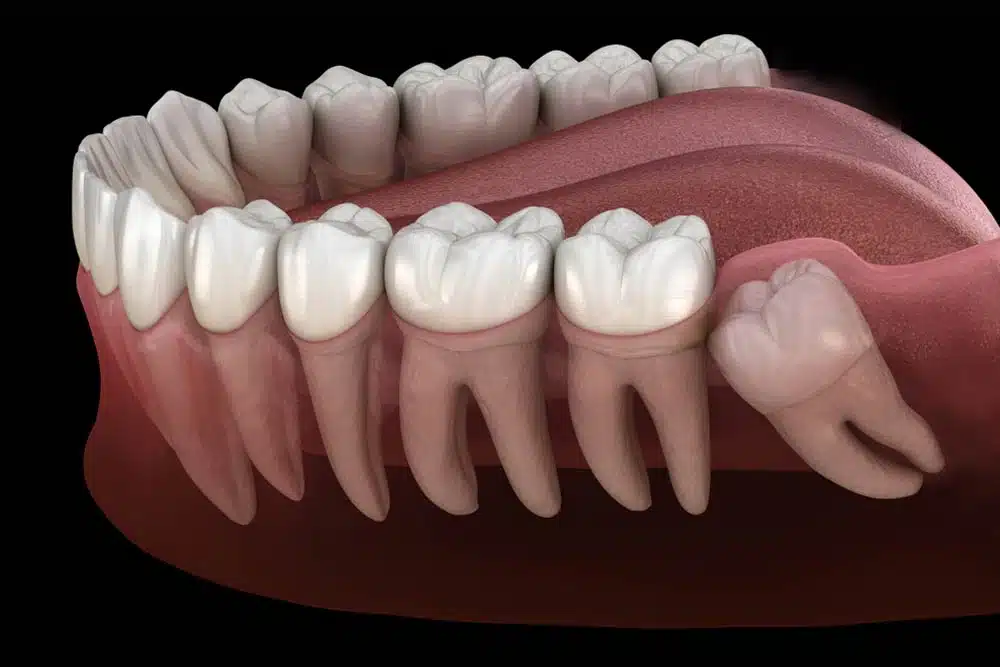 3D Illustration Of Wisdom Tooth