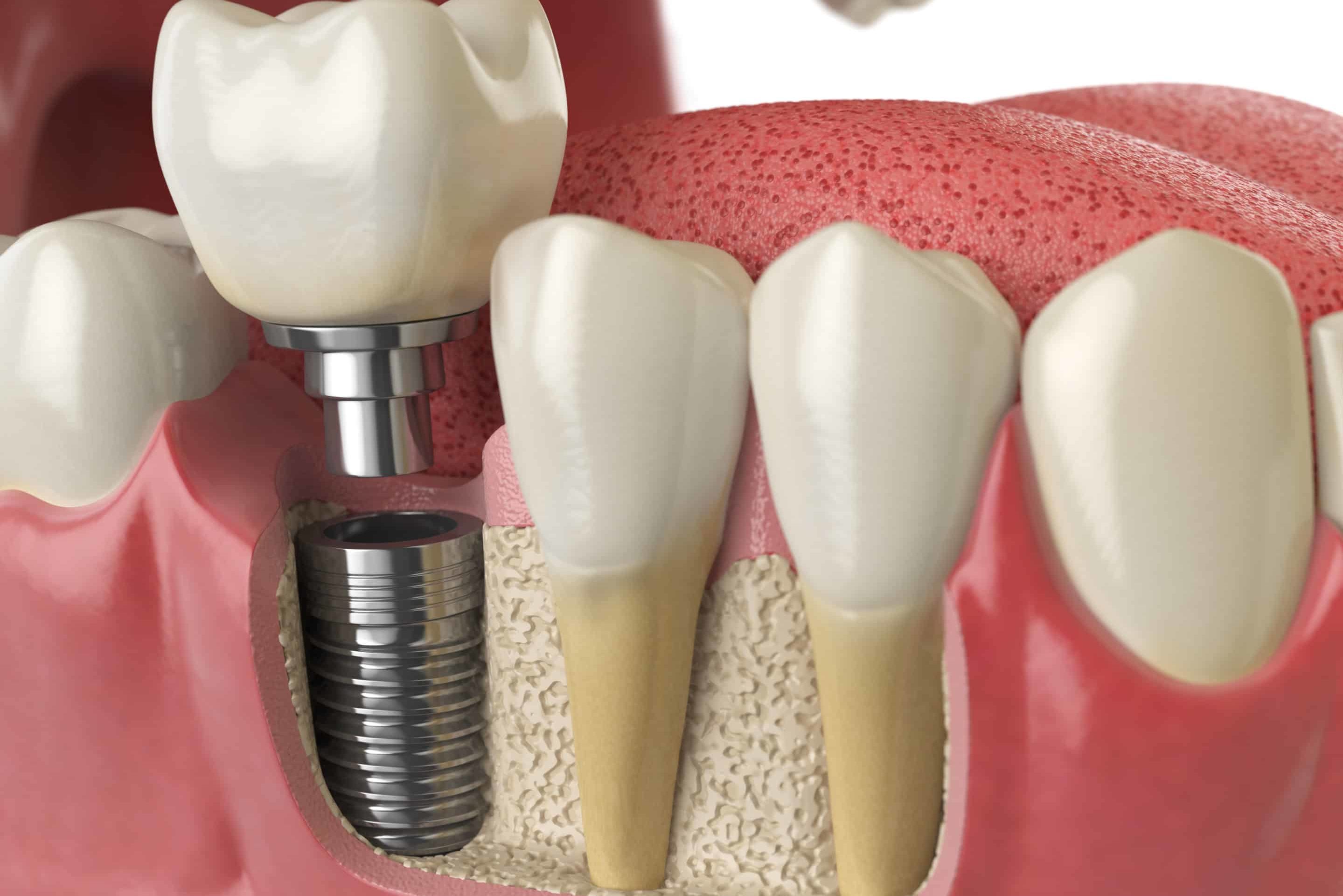 tooth dental implant
