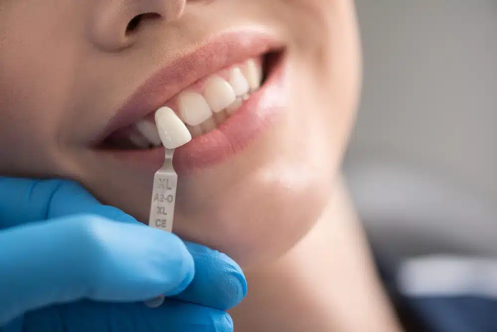 professional teeth whitening procedure