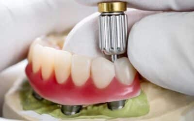 How to Care for Your Dental Implants Post-Surgery