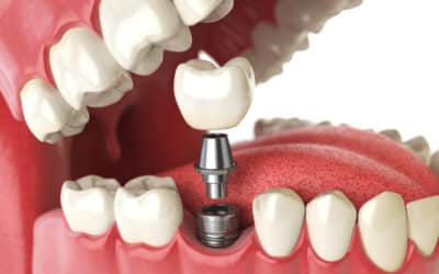 Implant-Supported Dentures: A Stable Solution