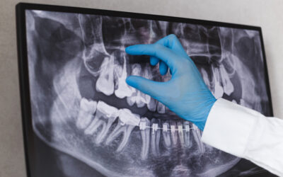Understanding the Progression of Untreated Dental Problems